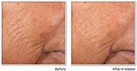 Roc Retinol Correx.line Smooth.night Serum Caps 30 - thumbnail