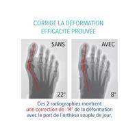 Epitact Dubbel Corrigerende Orthese met Epithelium - thumbnail