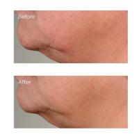 Perricone MD High Potency Growth Factor Firming & Lifting Eye Serum - thumbnail