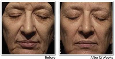 RoC Retinol Correxion® Wrinkle Correct Night Cream - thumbnail