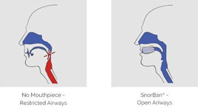 Snorban Anti-Snurk Beugel
