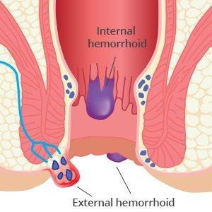 Hemapro Crème