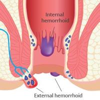 Hemapro Crème - thumbnail
