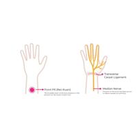 Sea Band Polsband zwangerschap roze 1 Paar - thumbnail