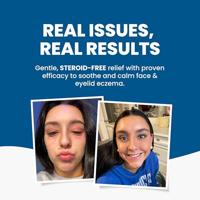 Gezicht & ooglid eczeem creme 50 Gram - thumbnail