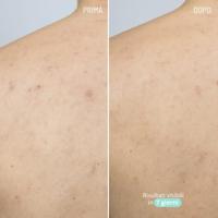 Freshly Cosmetics Azelaic Active Body Treatment 100 ml - thumbnail