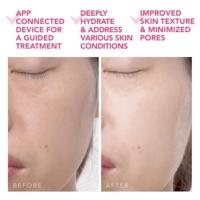 Foreo Ufo 2 Power Mask & Light Therapy - Fuchsia 1 stuk 1 pc - thumbnail