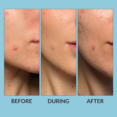 Gezichtspleisters Talika Free Skin Anti mee-eters 25 Stuks