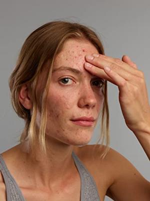 Gladskin Acne gel 30 Milliliter Gladskin Acne gel 30 Milliliter