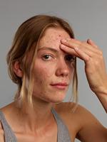 Gladskin Acne gel 30 Milliliter - thumbnail