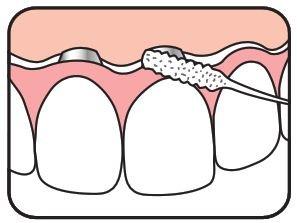 Tepe Bridge & Implant Floss Fil Dentaire 30 672250