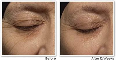 RoC Retinol Correxion® Wrinkle Correct Night Cream - thumbnail