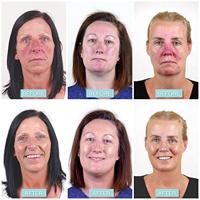 Rosalique Anti redness miracle formula 30 Milliliter - thumbnail