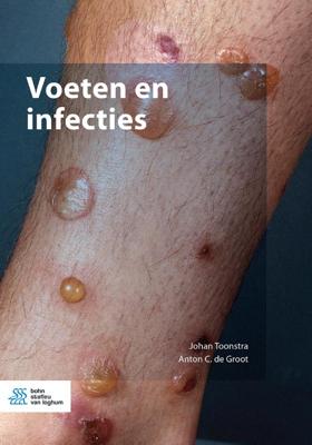 Voeten en infecties (Paperback)