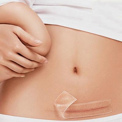 Organische siliconen gel litteken therapie patch worden gewassen en hergebruikt