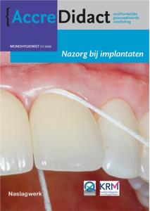 Nazorg bij implantaten (Paperback)