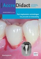 Peri-implantaire ontstekingen (Paperback)
