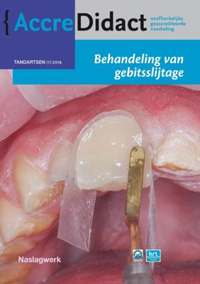 Behandeling van gebitsslijtage (Paperback)