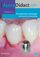 Peri-implantaire ontstekingen (Paperback)